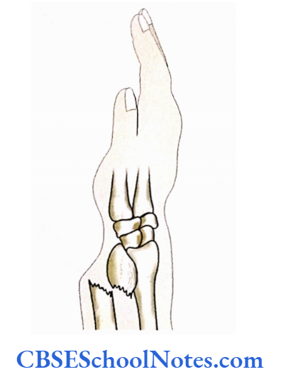 Bones Of The Upper Limb Colles's fracture