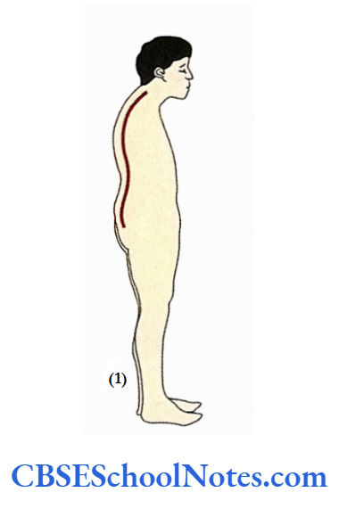 Bones Of The Vertebral Column Kyphosis Is An Increases In Thronic Concavity