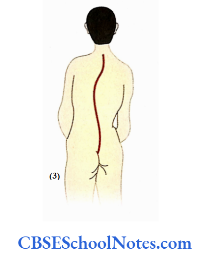 Bones Of The Vertebral Column Scoliosis Is Abnormal Lateral Curve