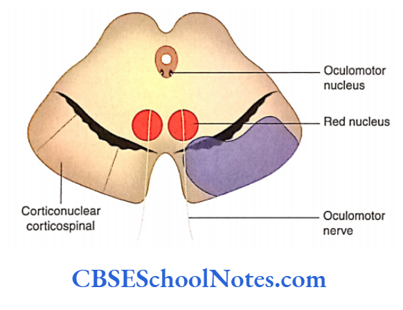 Brainstem Midbrain Weber's syndrome, due to occlusion of the Posterior cerebral Artery
