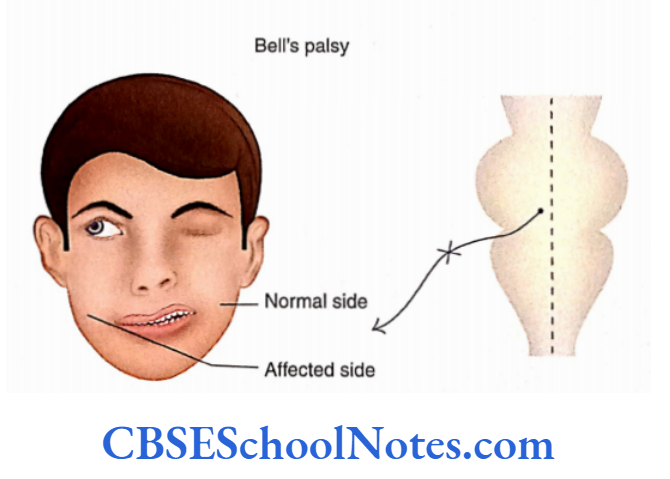Cranial Nerve Nuclei And Functional Aspects Bell's palsy may result due to a lesion of the facial Nerve In The Facial Canal Or Stylomastoid Foramen