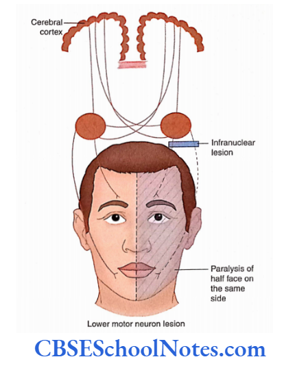 Cranial Nerve Nuclei And Functional Aspects Infranuclear facial palsy