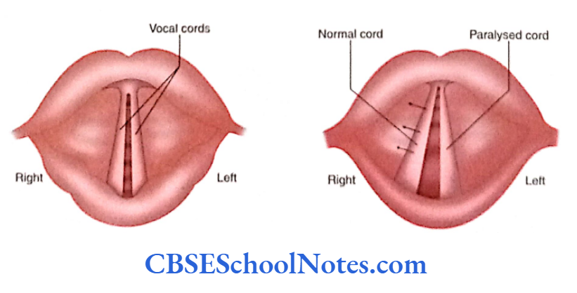 Cranial Nerve Nuclei And Functional Aspects Paralyses of vocal cords following vagus nerve palsy