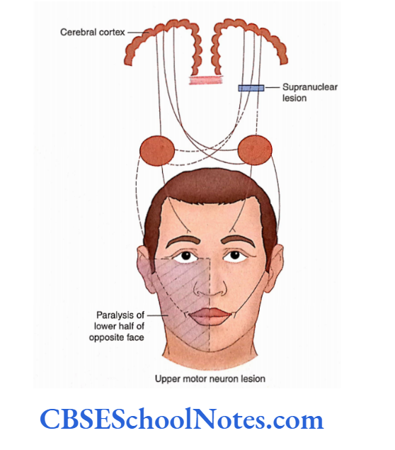 Cranial Nerve Nuclei And Functional Aspects Supranuclear facial palsy