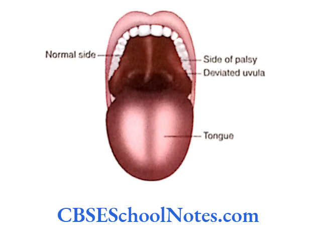 Cranial Nerve Nuclei And Functional Aspects When the patient opens the mouth and says'ahh', the asymmetry In the palatal arches is observed.