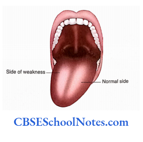 Cranial Nerve Nuclei And Functional Aspects When the patient protrudes the tongue, it deviates towards the side of the weakness