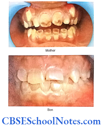Genetics In Dentistry Genetics Genetics Of Developmental Disorders Of Teeth Dentinogenesis imperfecta in a mother and her son