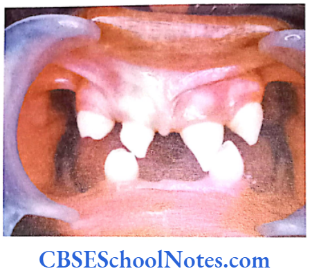 Genetics In Dentistry Genetics Genetics Of Developmental Disorders Of Teeth Patient of ectodermal dysplasia showing developmental lack of teeth