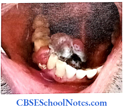 Genetics In Dentistry Genetics Of Cancer Patient showing a malignant melanoma lesion