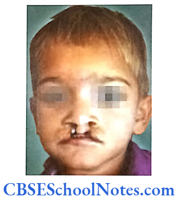 Genetics In Dentistry Genetics Of Cleft Lip And Cleft Palate Patient showing bilateral cleft-lip