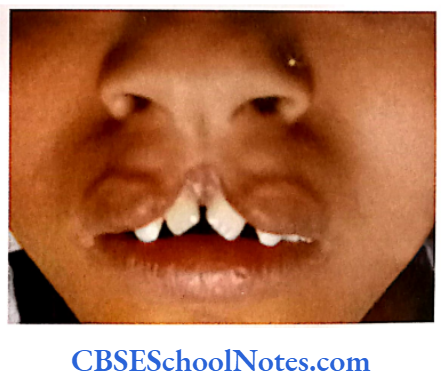 Genetics In Dentistry Genetics Of Cleft Lip And Cleft Palate The median cleft lip