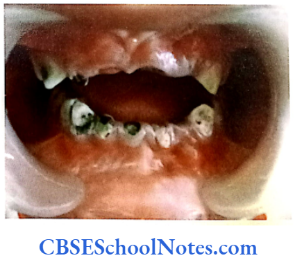 Genetics In Dentistry Genetics Of Dental Caries Full mouth case of early childhood caries