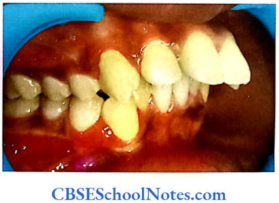 Genetics In Dentistry Genetics Of Malocclusion Patient showing Class 2 malocclusion
