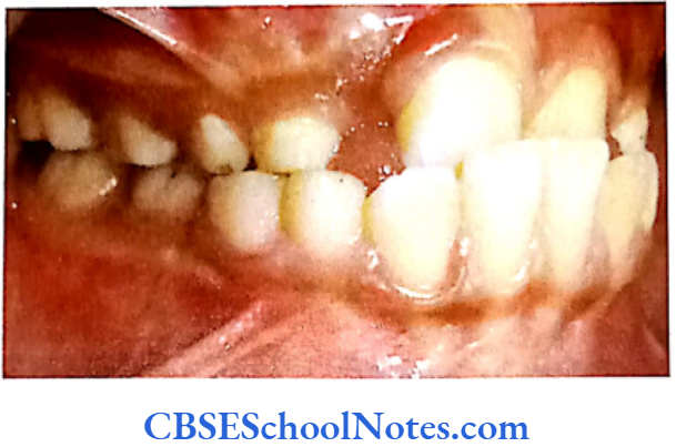 Genetics In Dentistry Genetics Of Malocclusion Patient showing Class 3 malocclusion