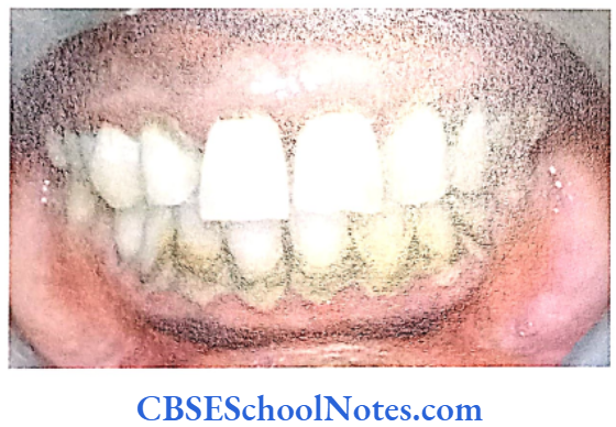 Genetics In Dentistry Genetics Of Periodontitis Patient showing chronic generalized periodontitis