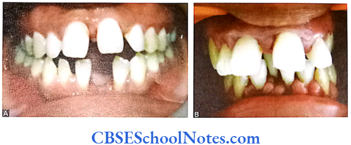 Genetics In Dentistry Genetics Of Periodontitis Patient showing localized aggressive