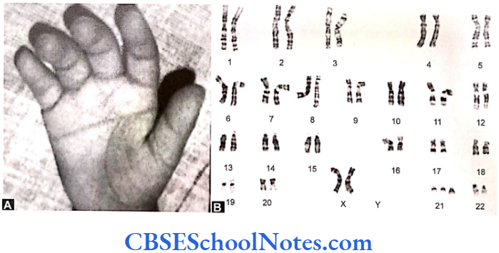 Genetics In Dentristry Chromosomal Anomalies Palmar simian crease in a child with Down's syndrome