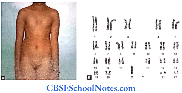 Genetics In Dentistry Chromosomal Anomalies Photograph of an 18 year old female with turner's syndrome