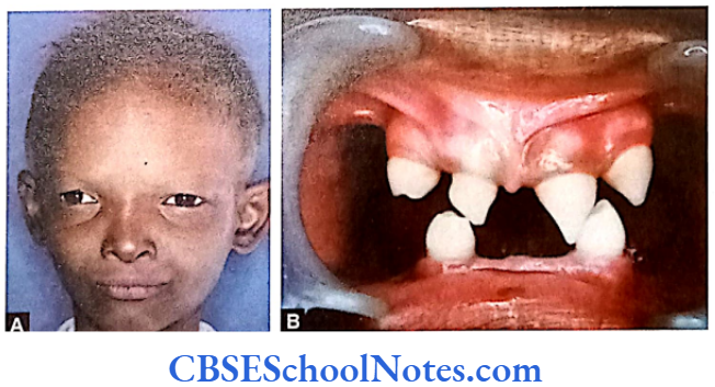 Genetics In Dentristry Genetics Of Craniofacial Disorders And Syndrome Patient of anhidrotic ectodermal dysplasia