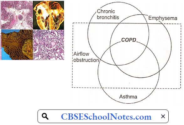 Airway Obstruction Is A Feature Common ToBronchial Asthma Chronic Bronchitis And Emphysema