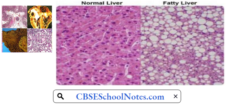 Basic Principles Of Cell Injury And Adaptation Fatty Change In The Liver