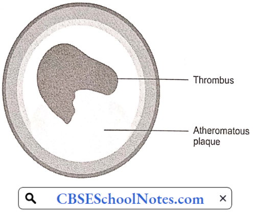 Coronary Thrombosis Over Atherosclerotic Plaque