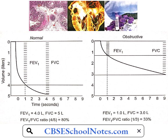 Decreased FFV Or FVC Ratio In Onbstructive Lung Disease