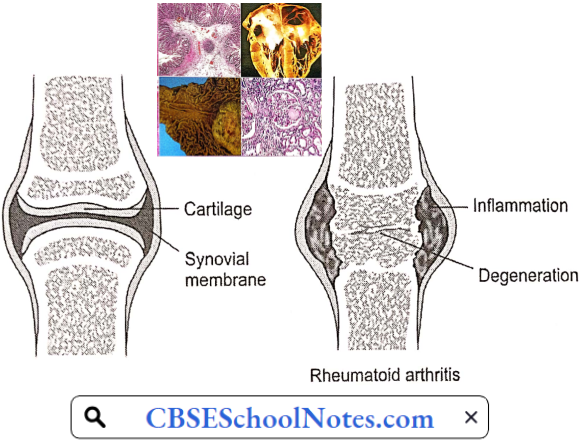 Disorders Of Bones and Joints Condition Of Synovial Joint In Rheumatoid Arthritis