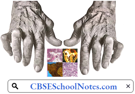 Disorders Of Bones and Joints Deformed Fingers In A Patient With Eheumatoid Arthritis