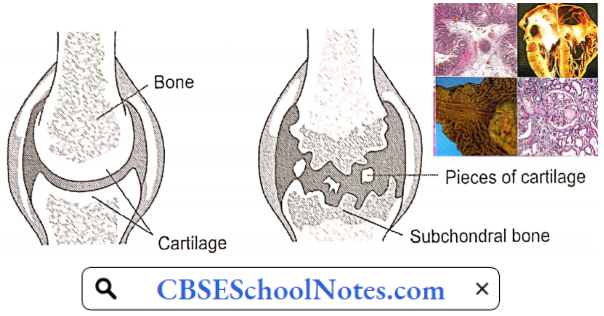Disorders Of Bones and Joints Degeneration Of Articular Cartilage And Bone In Osteoarthritis