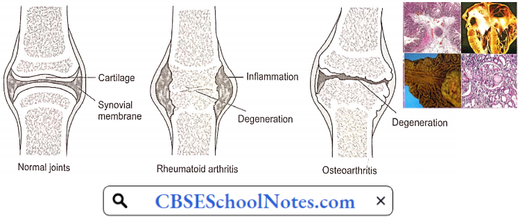 Disorders Of Bones and Joints Differences Between Rheumatoid Arthritis And Osteoarthritis