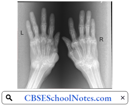 Disorders Of Bones and Joints Fused Bones Of The Wrist In Rheumatoid Arthritis