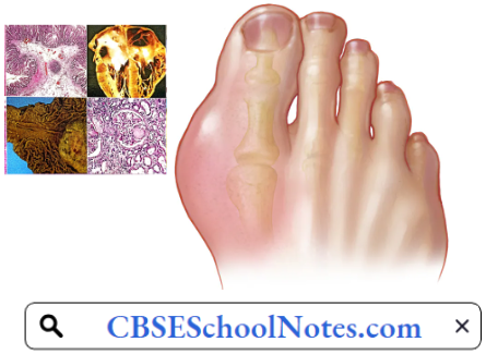Disorders Of Bones and Joints Gout