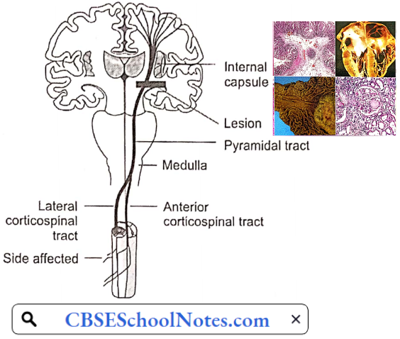Disorders Of Nervous System A Lesion In The Internal Capsule On The Left Side Resulst In Mirros Deficit On The Right Side Of The Body