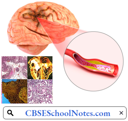 Disorders Of Nervous System Cerebral Infract