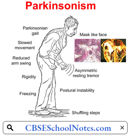 Disorders Of Nervous System Parkinsonism