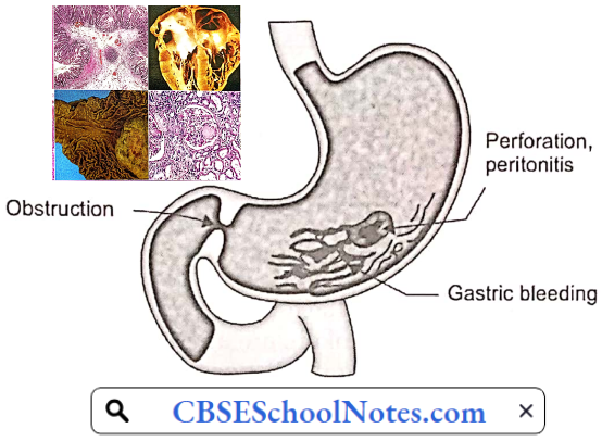 Disorders Of the Gastrointestinal System Complications Of Peptic Ulcer