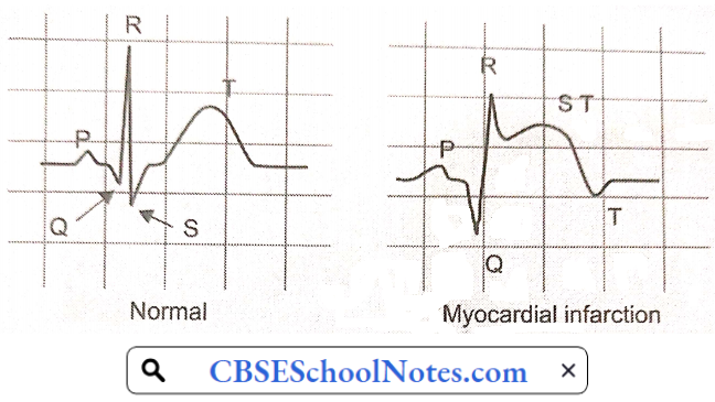 ECG In Myocardial Infraction