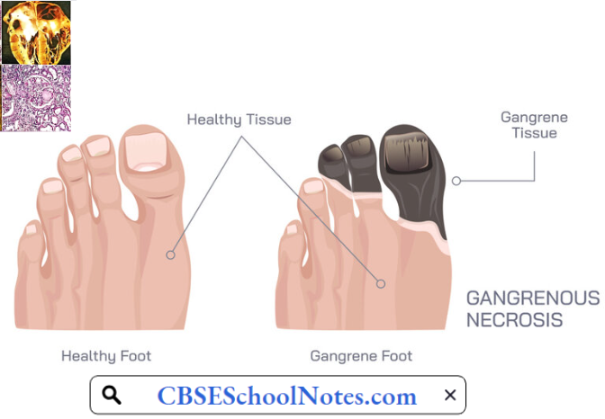 Endocrine Disorders Gangrene Foot In A patient Of Diabetes Mellitus