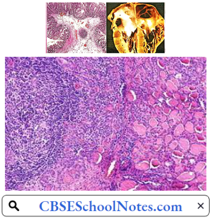 Endocrine Disorders Microscopic Apperance Of Hashimotos Thyroiditis