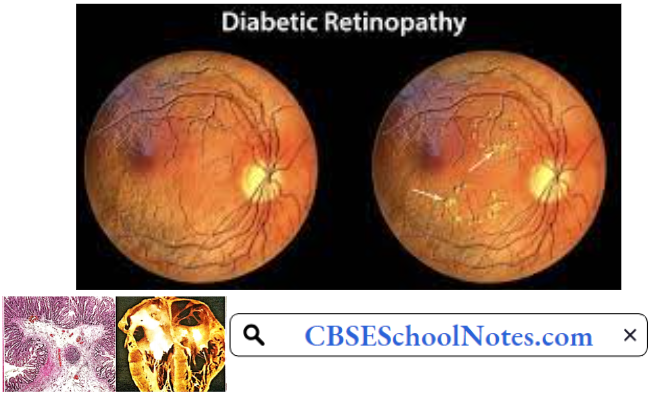 Endocrine Disorders Retina Normal And In Diabetic Retinopathy