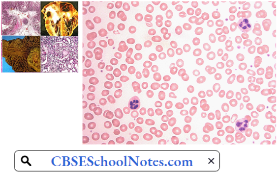 Hematological Disorders Blood Smear Of A patient Of Pernicious Anemia