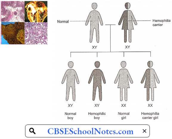 Hematological Disorders Genetics Of Hemophilia