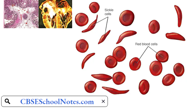 Hematological Disorders Sickle Cell Anemia