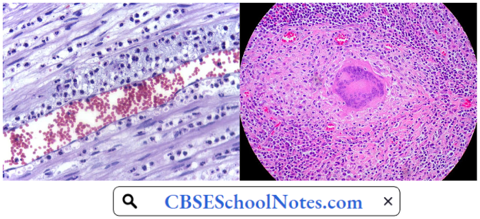 Histological Appearance Of Acute And Chronic Inflammation