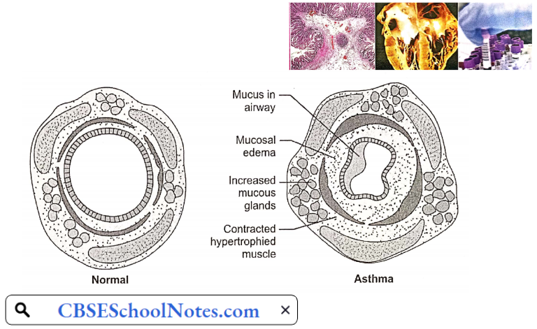 Histological Changes In The Bronchiole In Bronchial Asthma