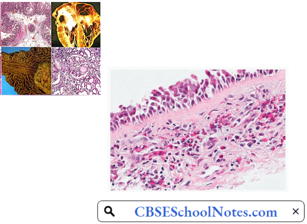 Histological Of A Bronchus In Chronic Bronchitis