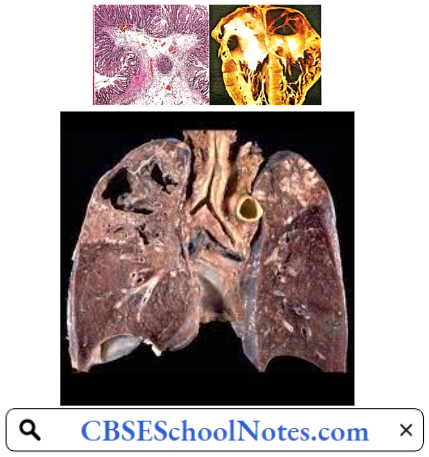 Infectious Diseases Tuberculosis Lungs Showing Cavities