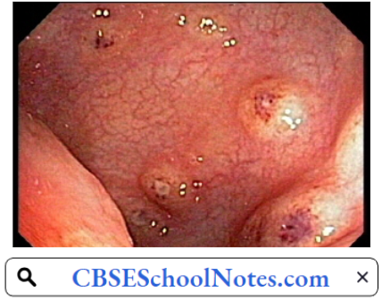 Infectious Diseases Typhoid Ulcer In Small Intestine